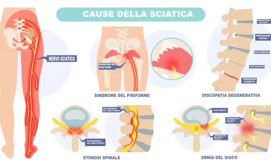 Sciatalgia, sintomi, cause e cosa fare nei primi giorni