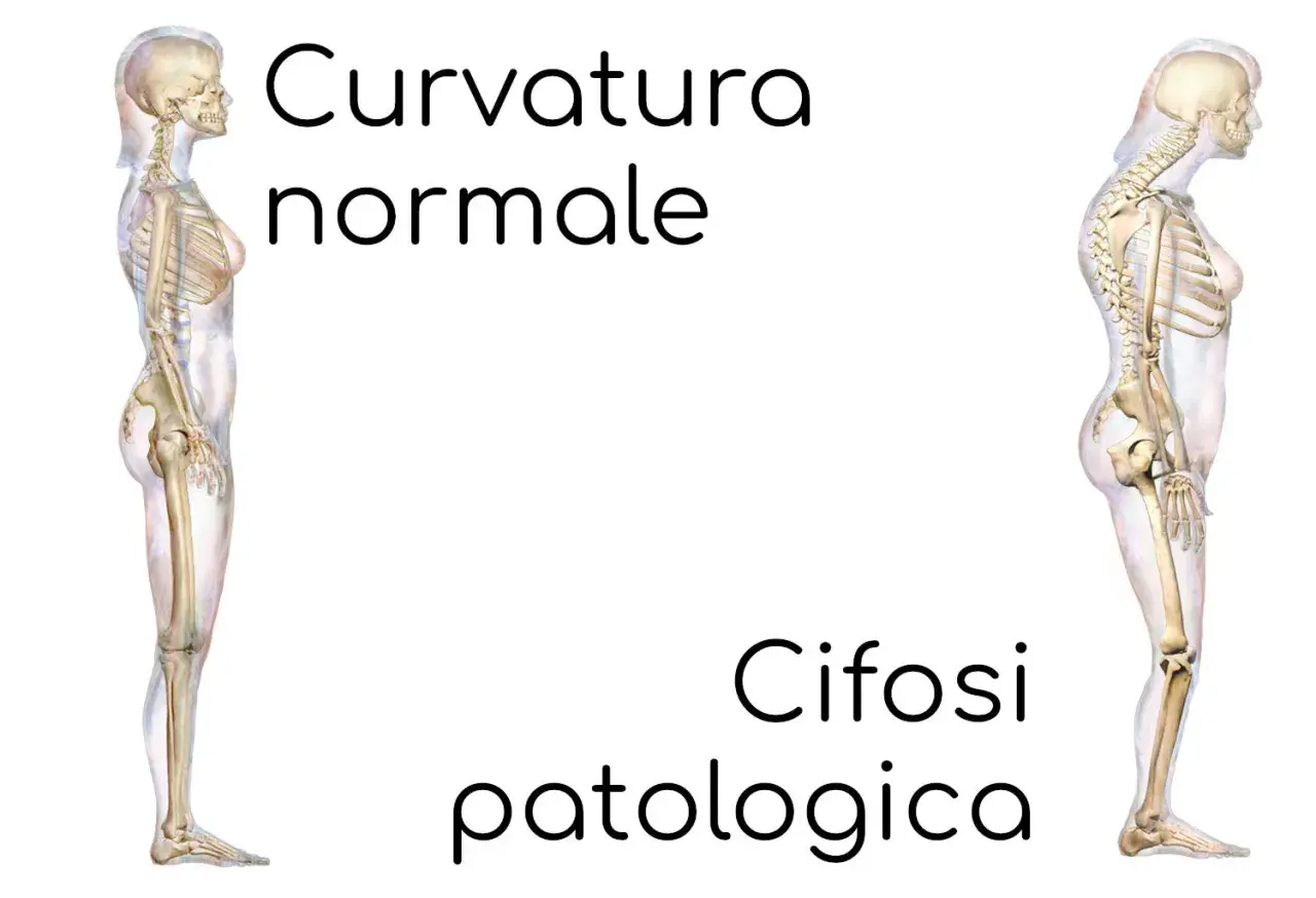 Scheletri a confronto: uno con curvatura normale, l'altro con cifosi patologica, evidenziando la curvatura lombare alterata.