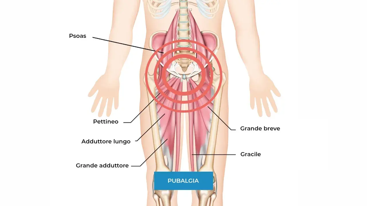Anatomia della pubalgia: focus su psoas, pettineo, adduttori e gracile. Scopri come curare la pubalgia velocemente con esercizi mirati.