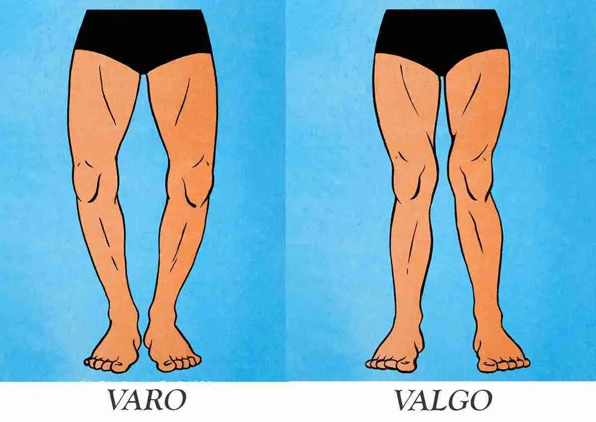 Gambe con valgismo (ginocchia a X) e varismo (ginocchia arcuate). Confronto visivo tra le due condizioni.