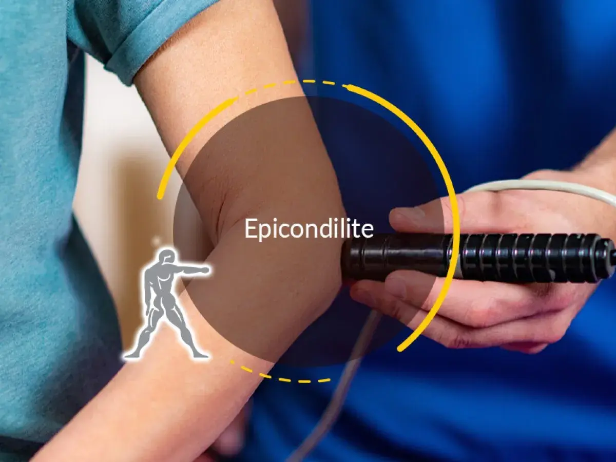 Trattamento per epicondilite: un dispositivo medico applicato al gomito per alleviare il dolore.
