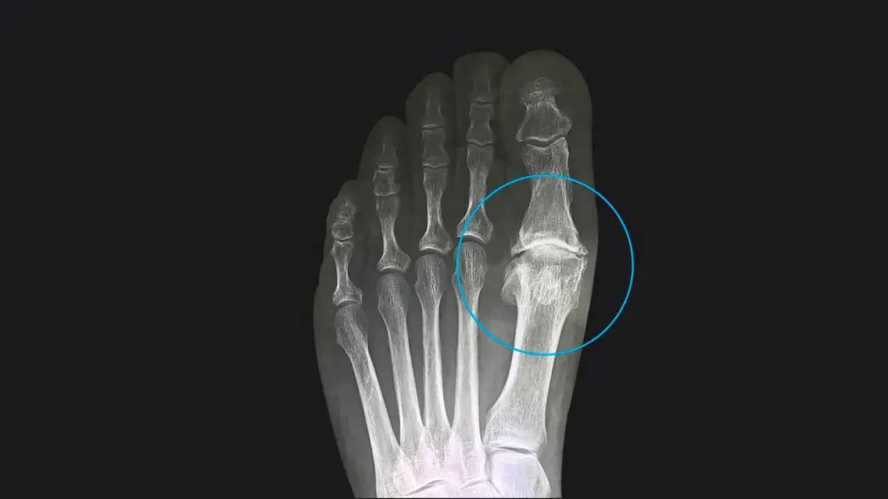 Radiografia del piede che evidenzia l'alluce rigido, con deformità e fusione ossea nell'articolazione metatarso-falangea.