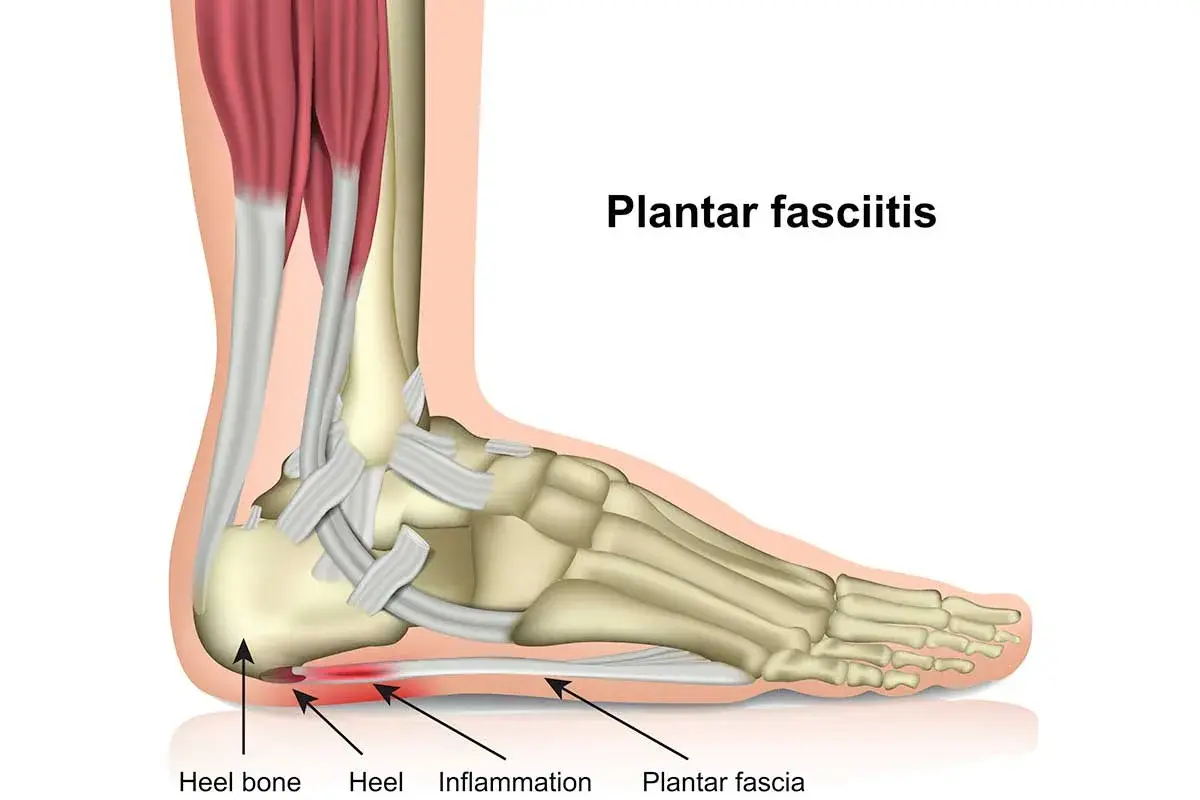 Anatomia del piede con fascite plantare, infiammazione del tallone. Il magnesio può aiutare.