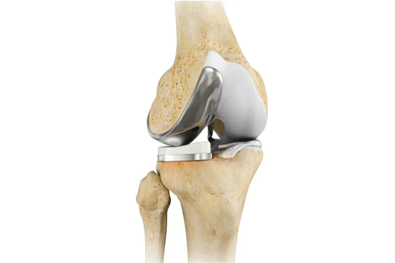 Protesi al ginocchio: un'immagine anatomica che mostra la sostituzione articolare. Quanto dura il dolore dopo la protesi al ginocchio?