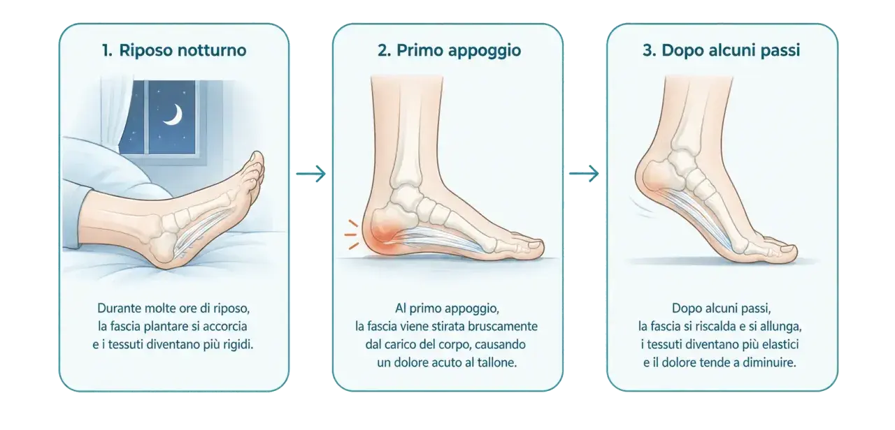 Il dolore al tallone peggiora al mattino, un classico della fascite plantare che non passa. L'immagine mostra come la fascia plantare si irrigidisce durante il riposo e si infiamma al primo passo.