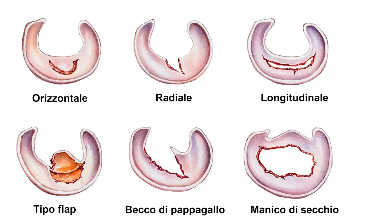 Illustrazioni di vari tipi di menisco rotto: orizzontale, radiale, longitudinale, a lembo, a becco di pappagallo e a manico di secchio.