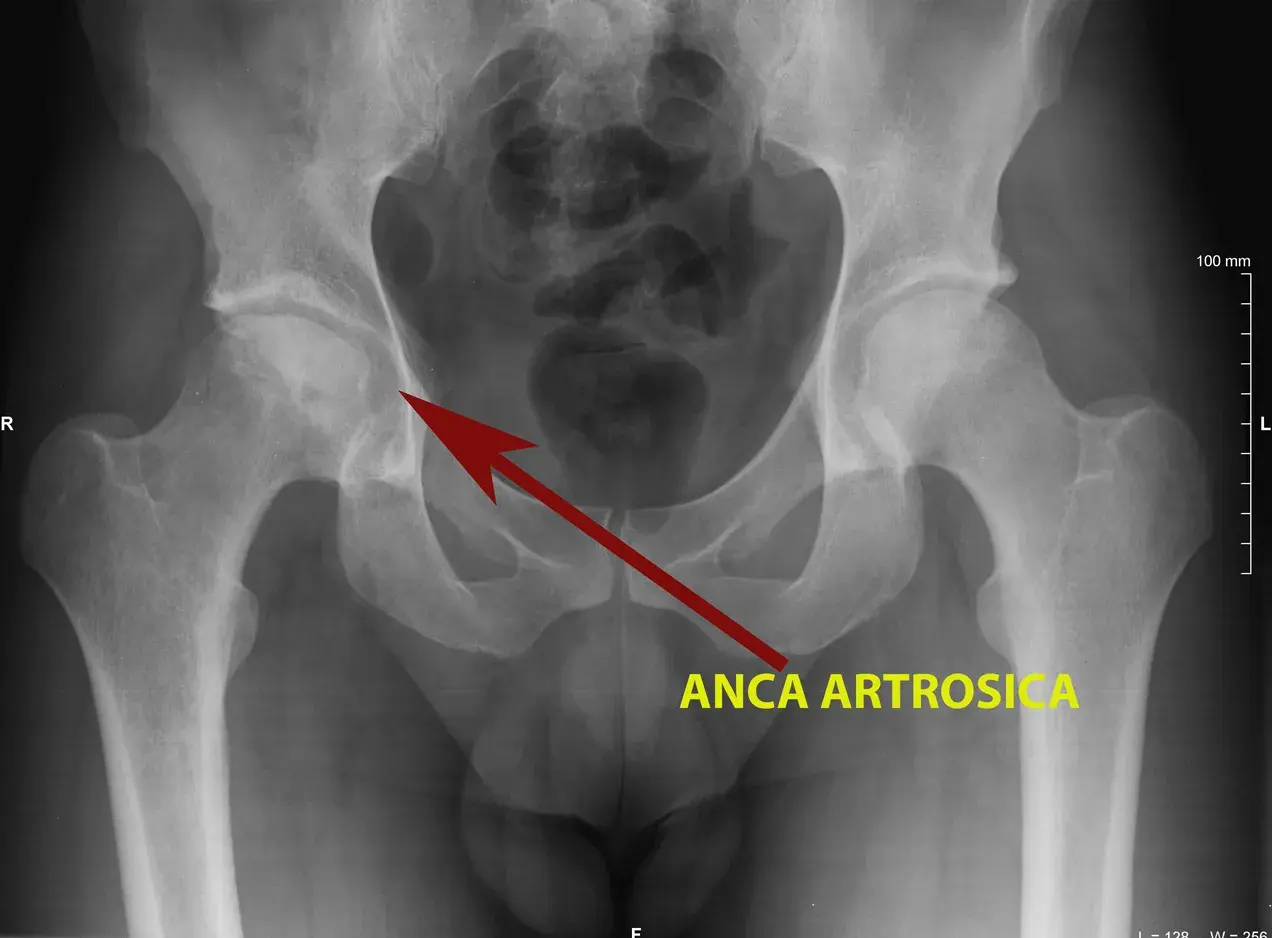 Radiografia del bacino che mostra un'anca artrosica, con freccia rossa che indica l'area interessata.