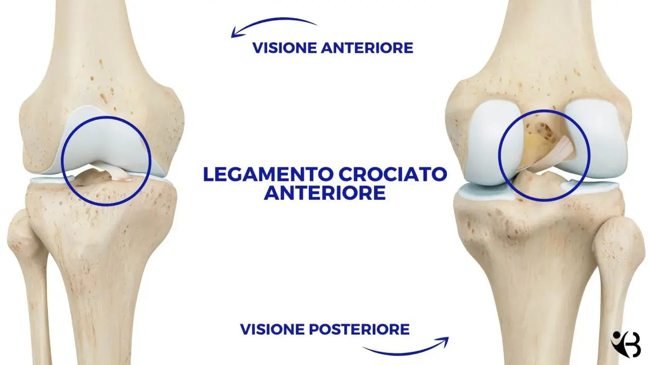 Legamento crociato anteriore rotto in visione anteriore e posteriore del ginocchio.