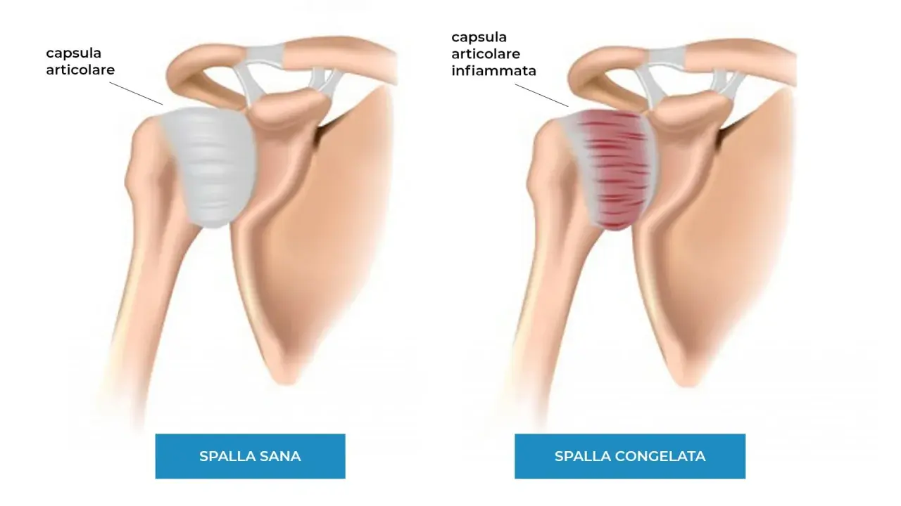 Spalla sana vs spalla congelata: la capsula articolare infiammata mostra i sintomi di dolore e rigidità.
