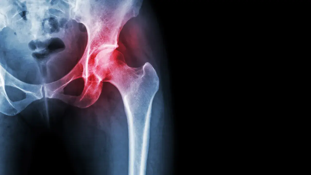 Radiografia del bacino con evidenza di trocanterite. Camminare fa bene per migliorare la mobilità dell'anca.