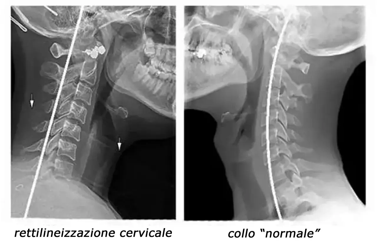 Radiografie cervicali: a sinistra, rettilineizzazione del rachide cervicale con frecce che indicano possibili conseguenze; a destra, collo "normale".