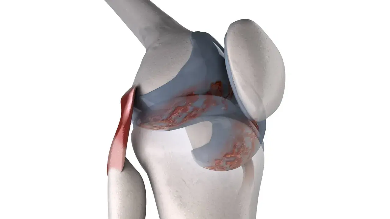 Dettaglio anatomico di un ginocchio con cartilagine danneggiata, che suggerisce ginocchia che scricchiolano.