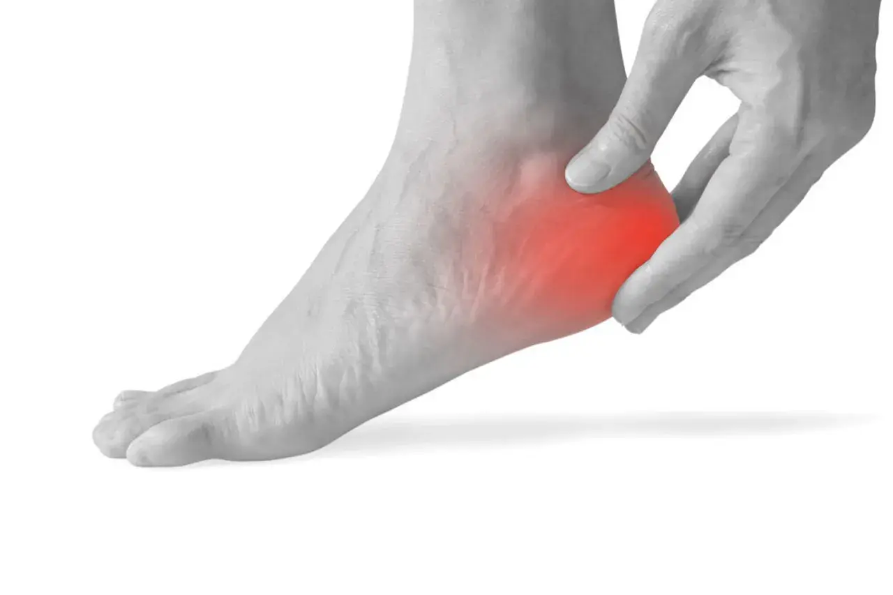 Piede con dolore al tallone, evidenziato in rosso. Utile per illustrare spina calcaneare esercizi.