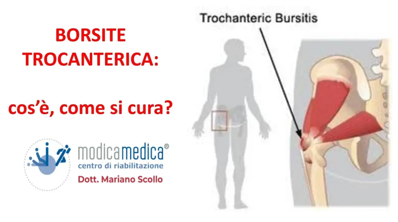 Borsite trocanterica che non passa? Immagine illustra la condizione e le opzioni di cura.