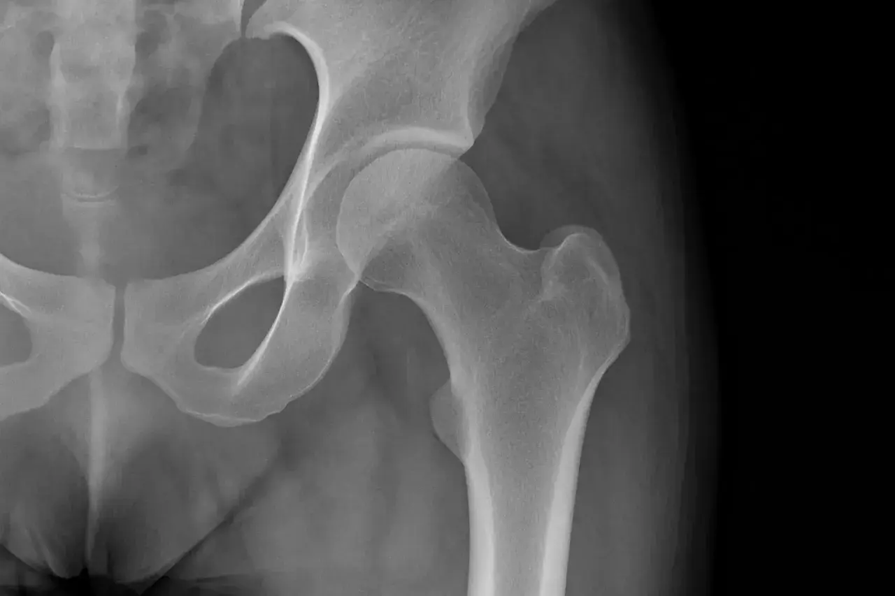 Radiografia dell'anca che mostra una calcificazione ossea.