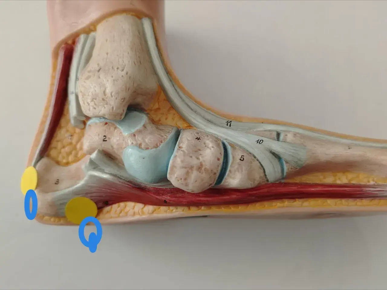 Modello anatomico del piede evidenzia la spina calcaneare trascurata, con aree di interesse cerchiate in giallo e blu.