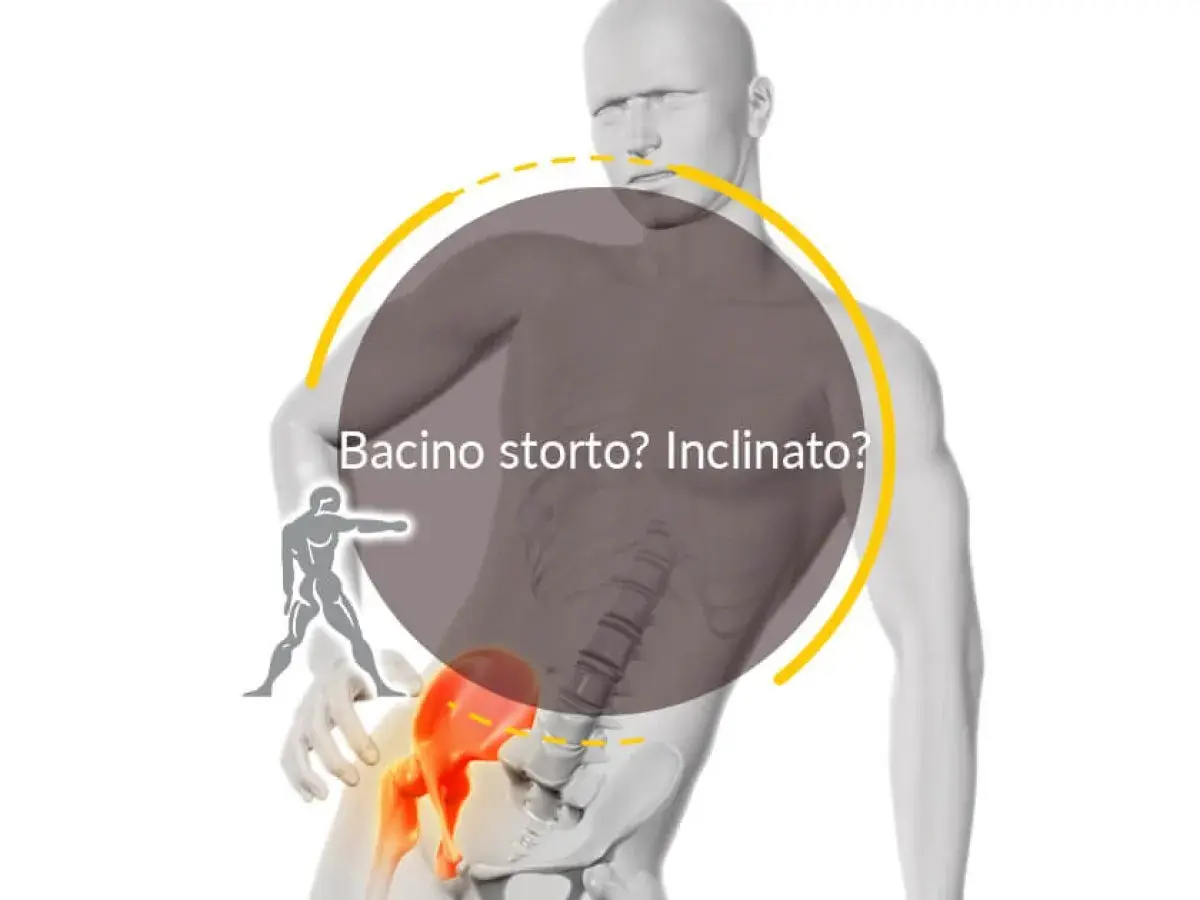 Un bacino ruotato può causare problemi neurologici. L'immagine mostra un modello anatomico con un bacino inclinato, evidenziato in rosso, e la scritta "Bacino storto? Inclinato?".