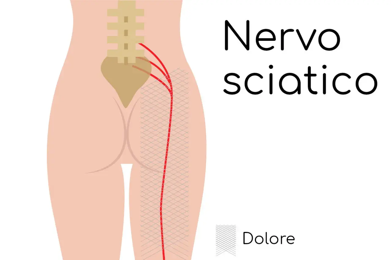 Illustrazione anatomica del nervo sciatico e del lombo cruralgia. Il dolore si irradia lungo la gamba.