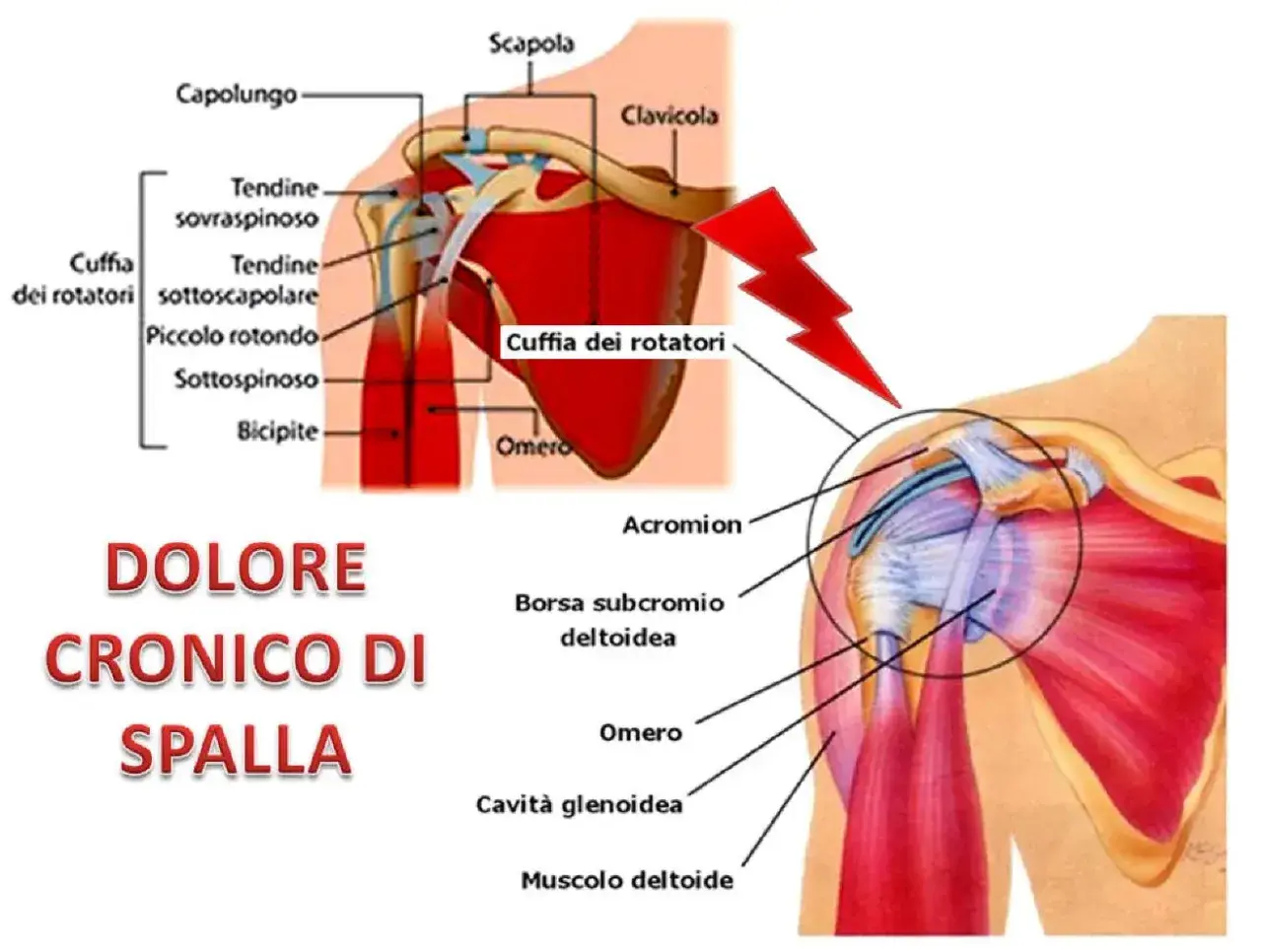 Dolore cronico di spalla destra quando alzo il braccio, con illustrazioni anatomiche della cuffia dei rotatori e dei muscoli della spalla.
