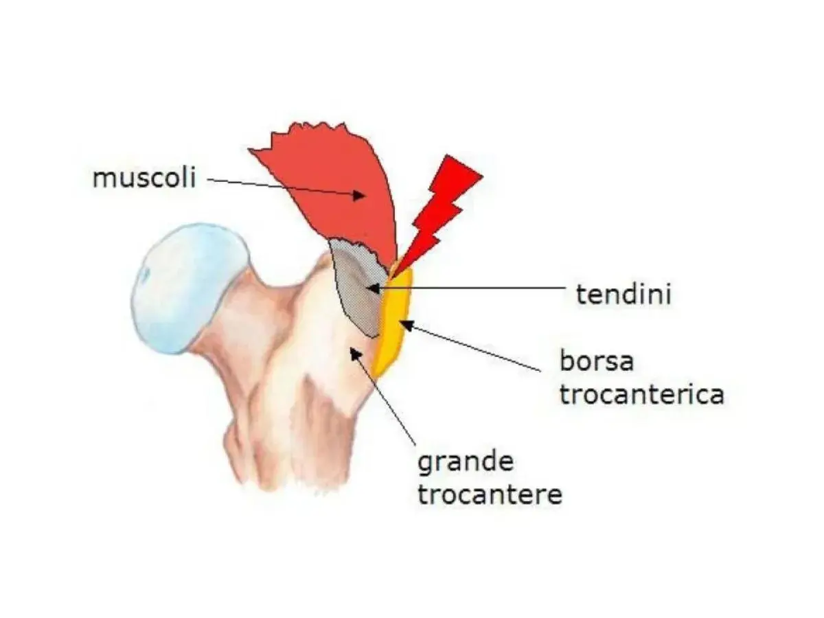 Diagramma anatomico dell'anca che mostra il grande trocantere, i muscoli, i tendini e la borsa trocanterica, evidenziando un'area di potenziale infiammazione.