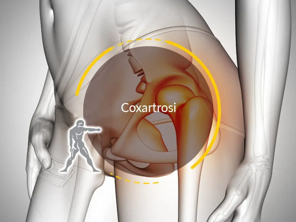Illustrazione anatomica che evidenzia la coxartrosi, causa di dolore all'anca. I sintomi possono variare.