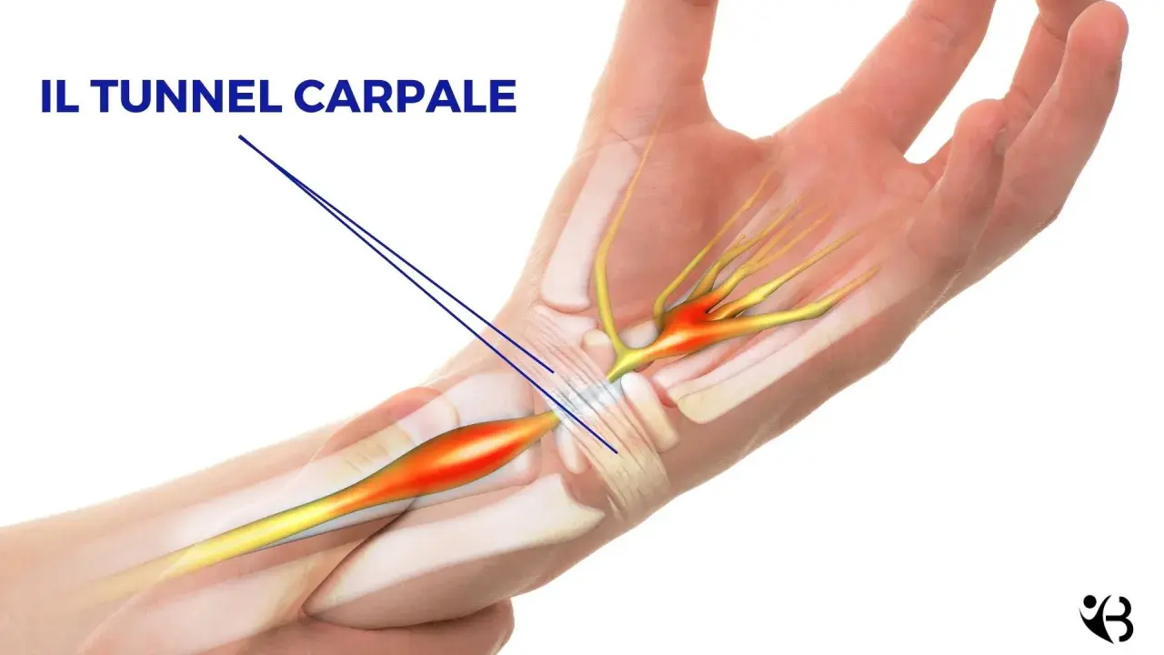 Illustrazione anatomica del tunnel carpale con evidenziata la compressione del nervo, che può richiedere un intervento.