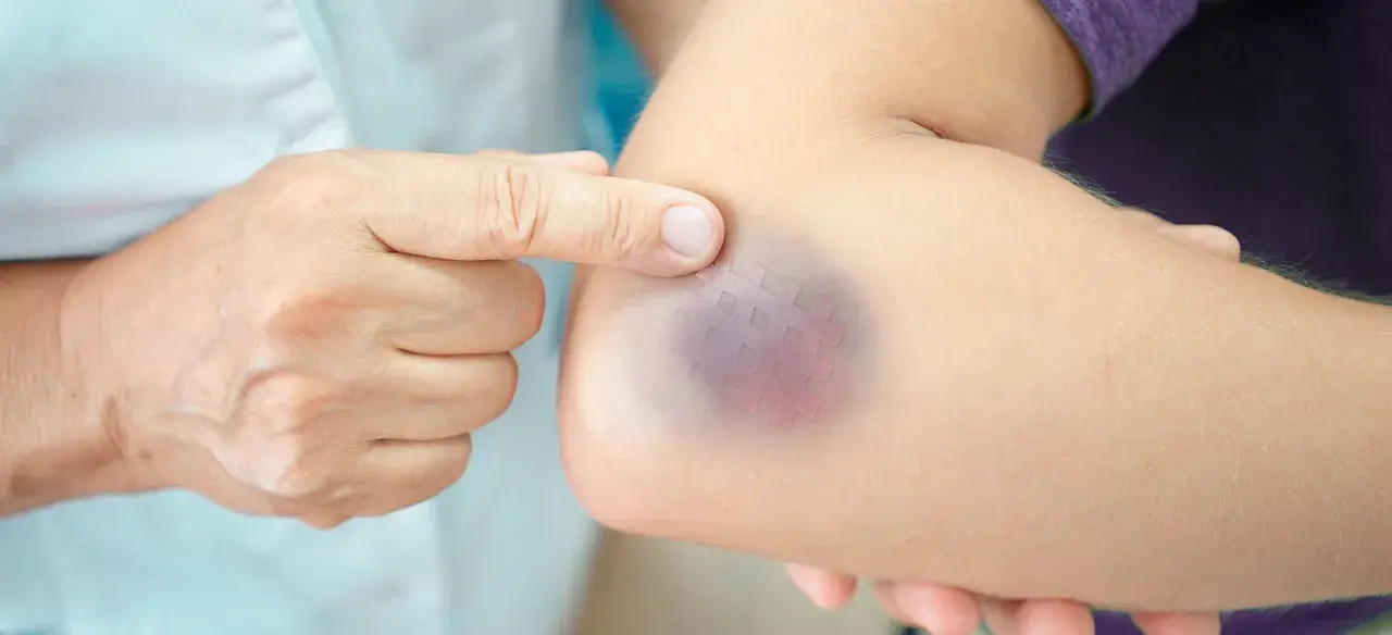 Dito un braccio con un livido viola e un cerotto a quadretti, segno di un trauma braccio dopo caduta.