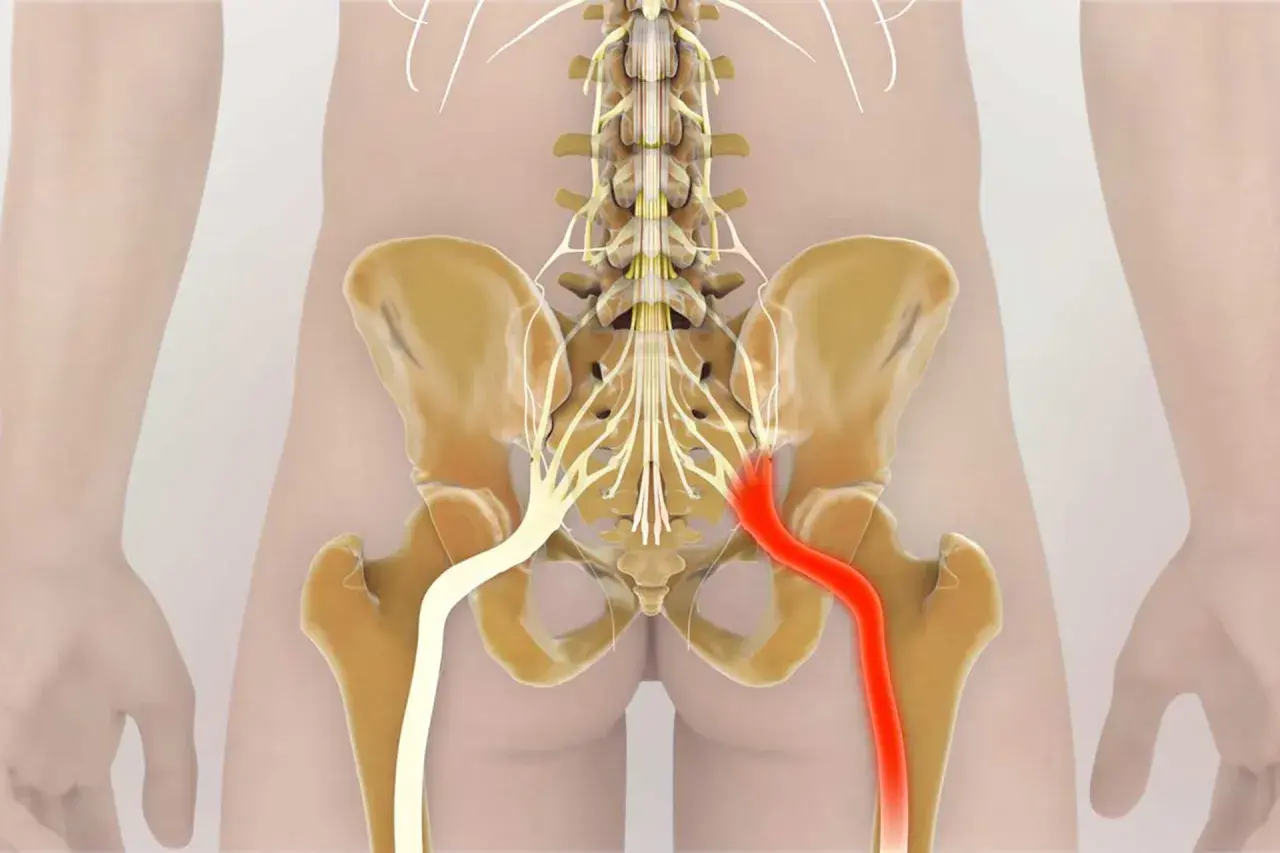 Illustrazione anatomica del nervo sciatico, con enfasi sui **sciatalgia sintomi inguine**. Il nervo destro è evidenziato in rosso, indicando potenziale irritazione o infiammazione.