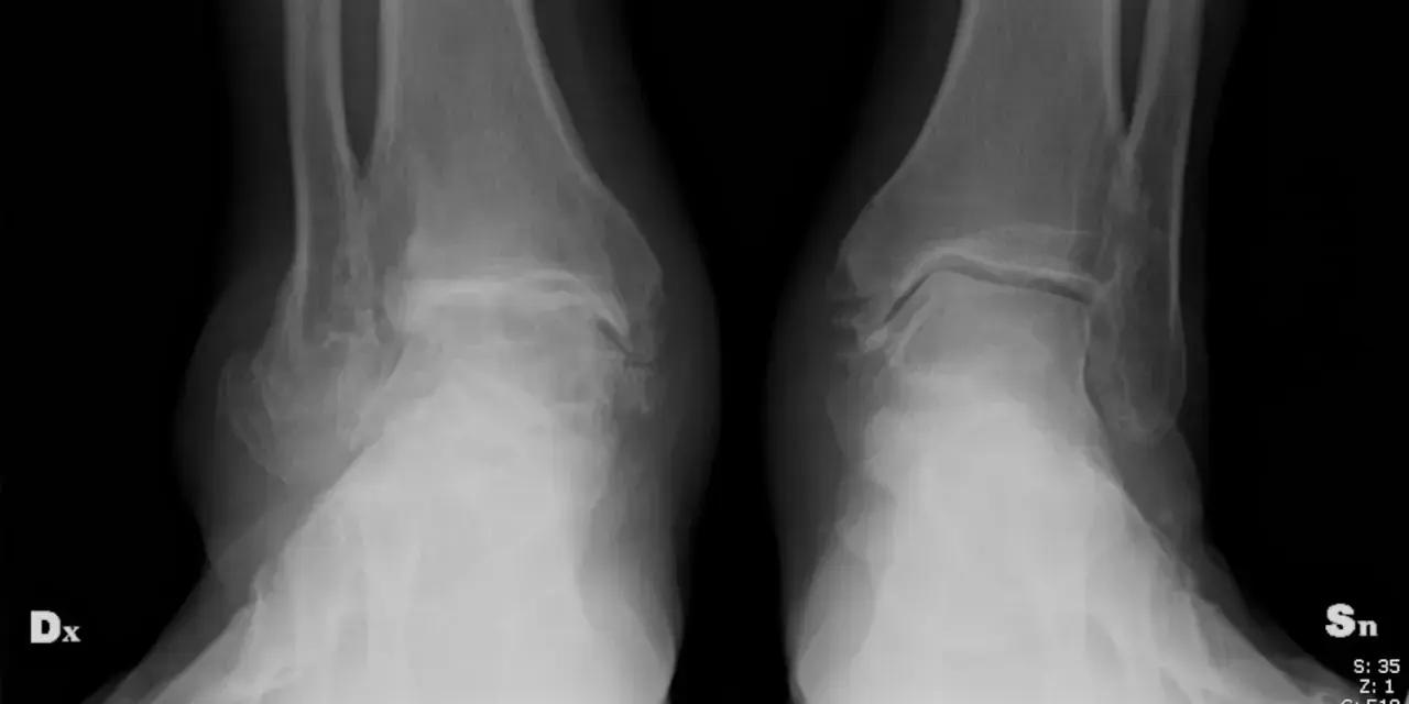 Radiografie delle caviglie mostrano segni di artrosi, con alterazioni ossee e riduzione dello spazio articolare.