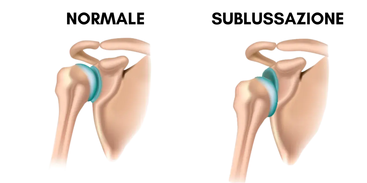 Spalla normale vs. sublussazione: quando il dolore spalla sinistra quando preoccuparsi? Illustrazione anatomica.