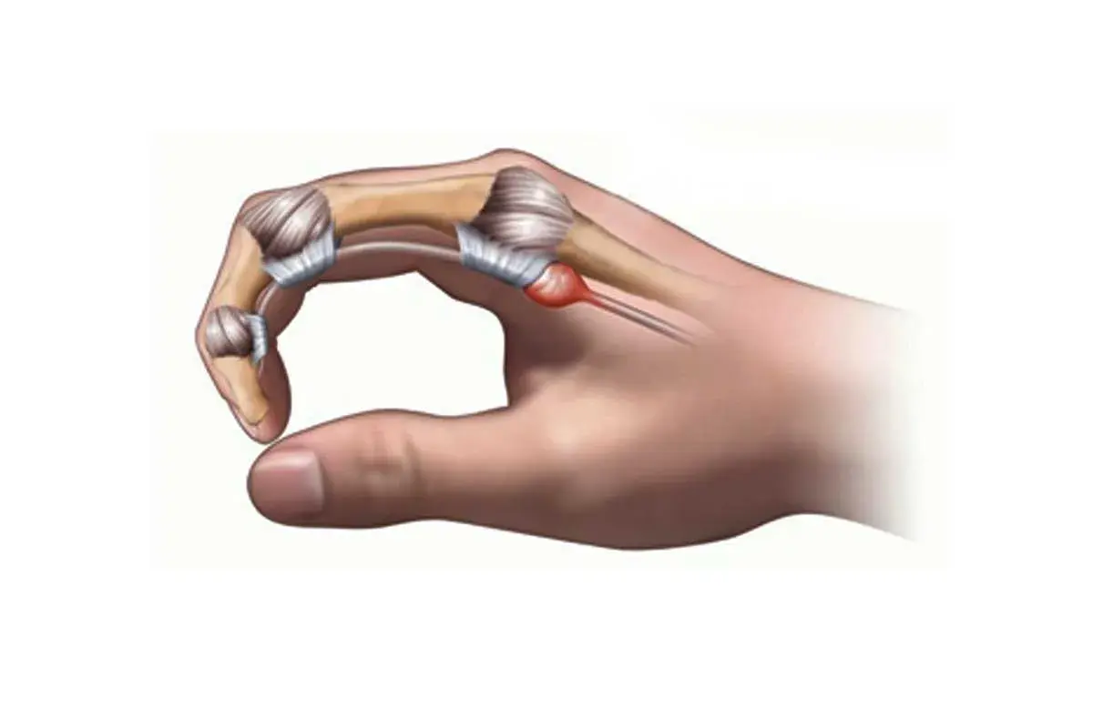 Dito cosa fare per il pollice a scatto: infiammazione del tendine e della guaina tendinea.