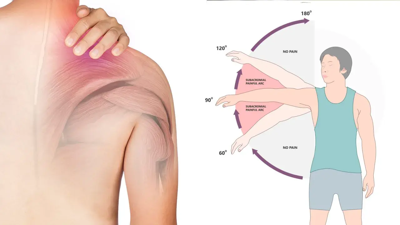 Illustrazione anatomica della spalla con dolore e diagramma che mostra gli esercizi per la spalla congelata, evidenziando l'arco doloroso.