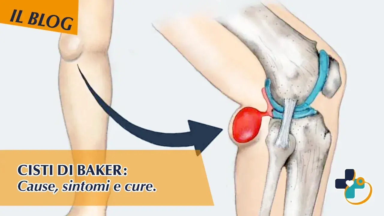 Illustrazione anatomica di una cisti di Baker nel ginocchio, con indicazioni su cause, sintomi e cure. I tempi di guarigione variano.