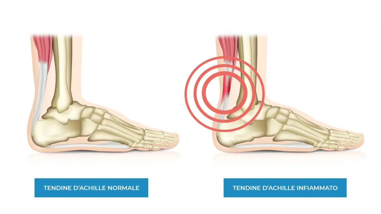 Confronto tra tendine d'Achille normale e infiammato. L'immagine mostra un piede con scheletro e muscolatura, evidenziando la differenza tra un tendine sano e uno irritato con cerchi rossi.