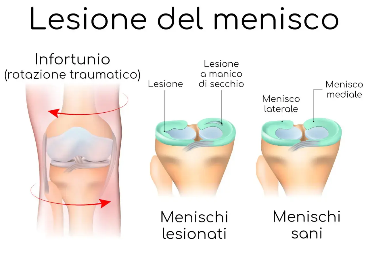 Illustrazione che mostra cos'è un menisco e le lesioni a manico di secchio, con menischi sani e lesionati.