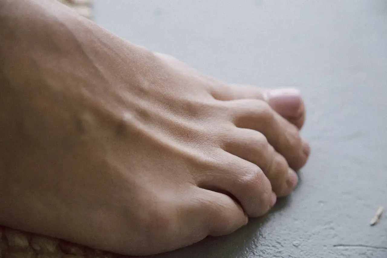 Piedi con gonfiore e arrossamento, possibili sintomi iniziali di artrite reumatoide.