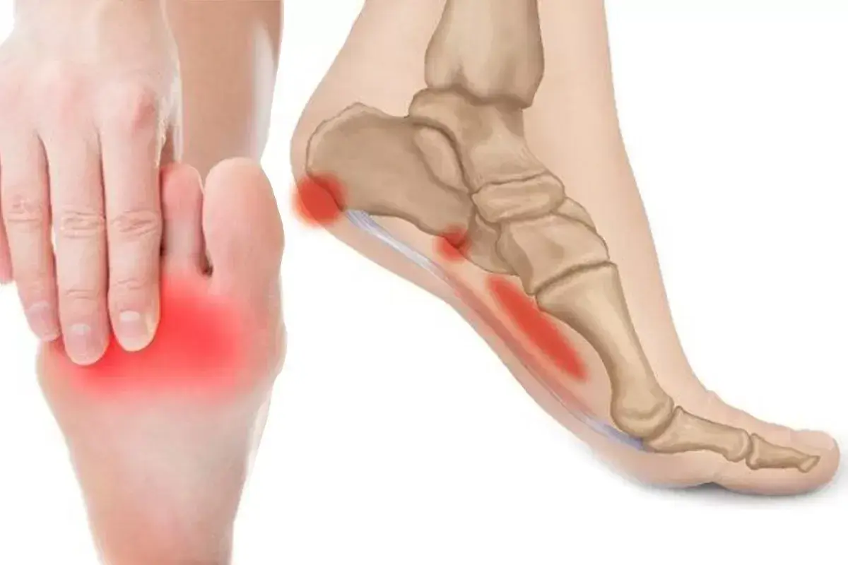 Dolore sotto tallone evidenziato in rosso su un piede e un'illustrazione anatomica.