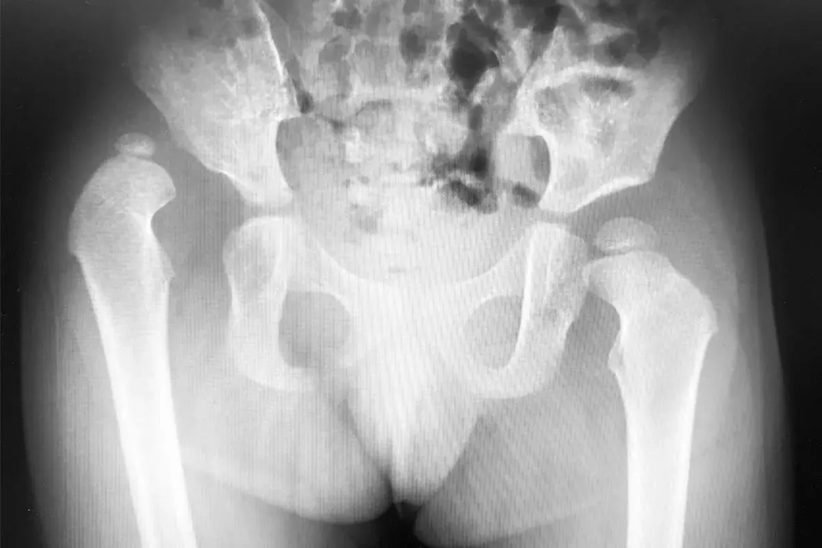 Radiografia del bacino e delle anche. Si nota una lussazione dell'anca, con implicazioni sui tempi di recupero.
