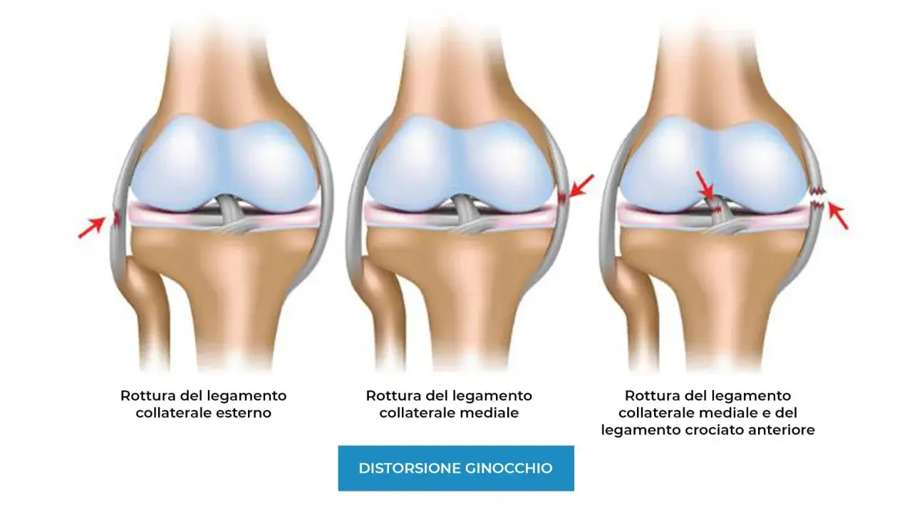 Illustrazione di ginocchia con lesioni ai legamenti: rottura del legamento collaterale esterno, mediale e crociato anteriore.