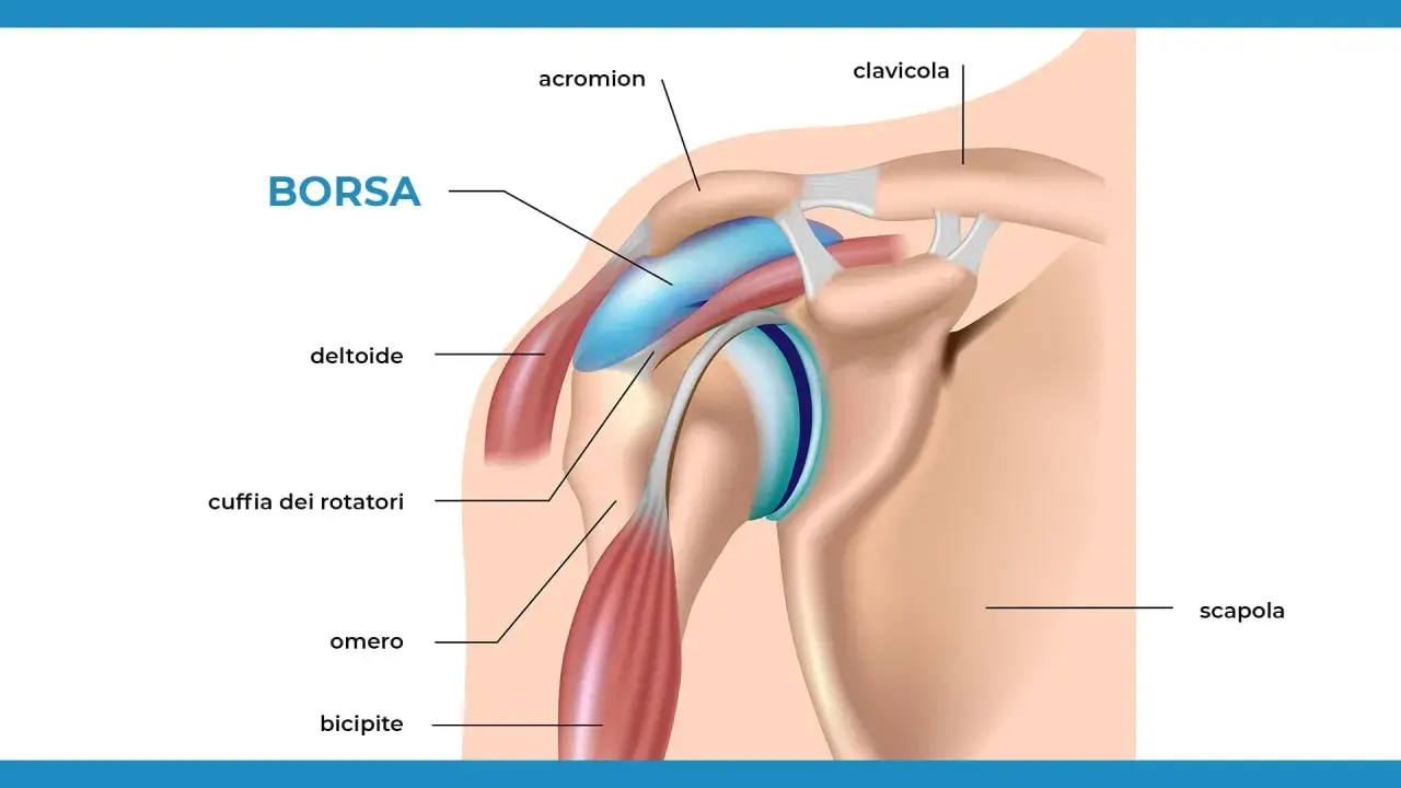Illustrazione anatomica della spalla con etichette. Si vede la borsa, il deltoide, la cuffia dei rotatori, l'omero, il bicipite, l'acromion, la clavicola e la scapola.