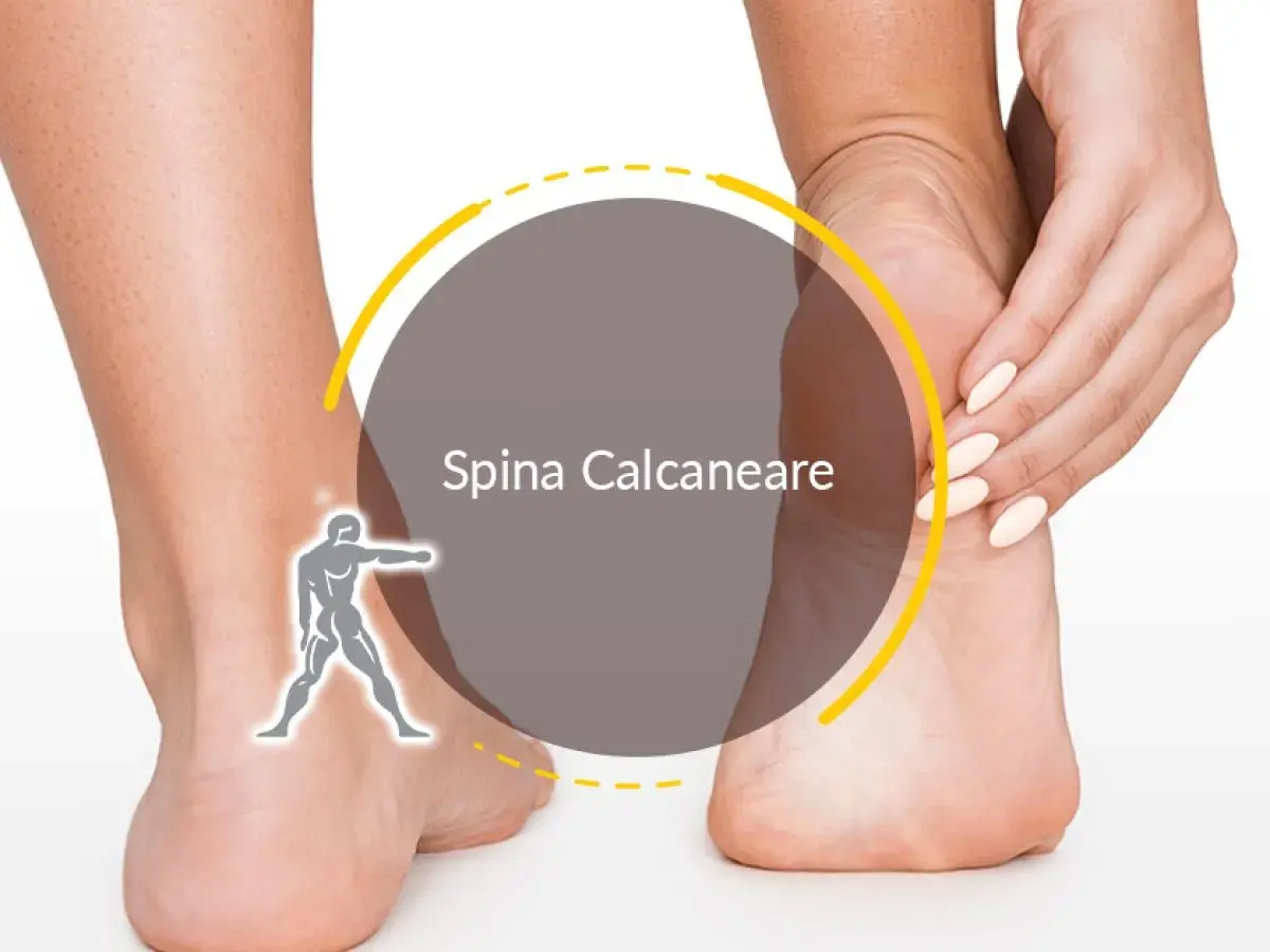 Dolore al tallone? La spina calcaneare può rendere difficile camminare, ma ci sono soluzioni.