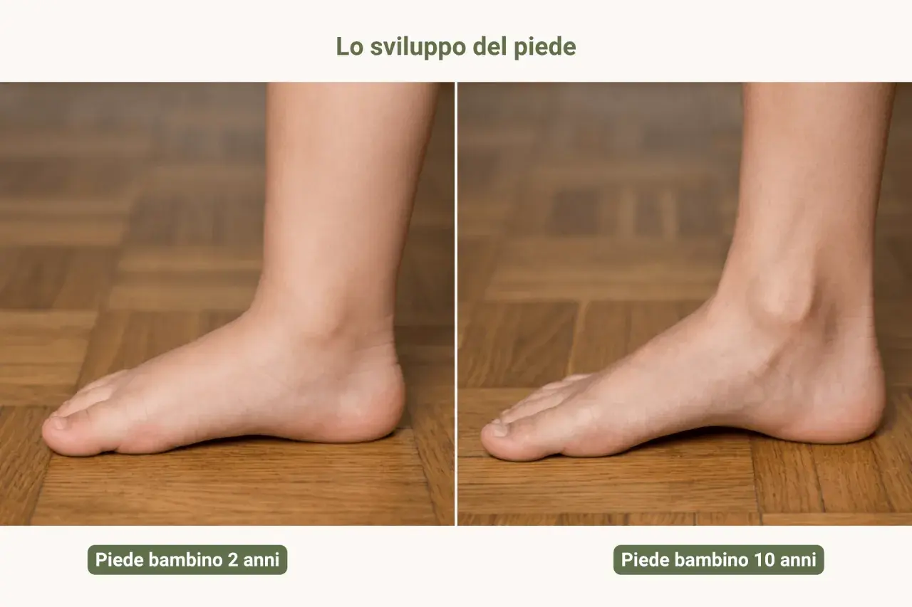Confronto tra piede valgo di un bambino di 2 anni e di 10 anni, mostrando l'evoluzione della volta plantare.
