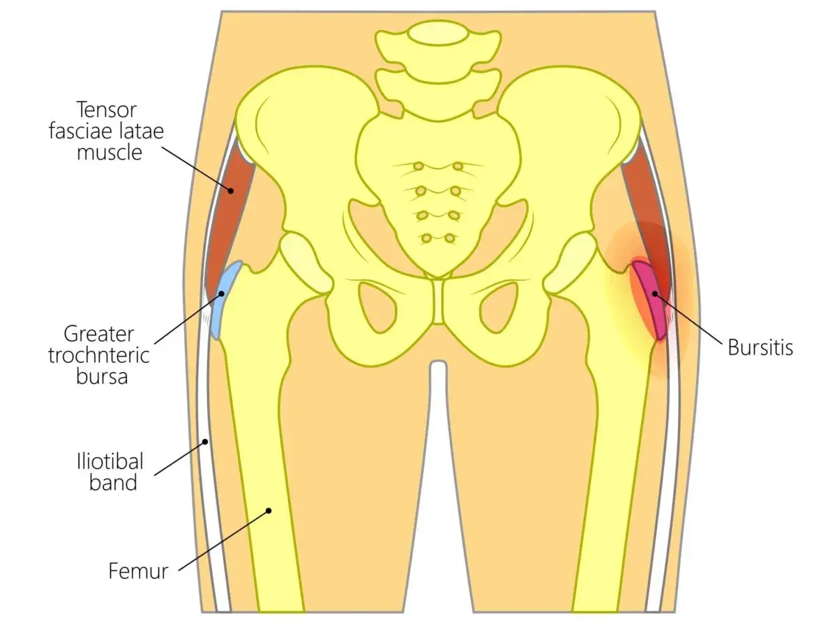 Illustrazione anatomica dell'anca che mostra la borsite trocanterica. Suggerimenti su come dormire con il dolore.
