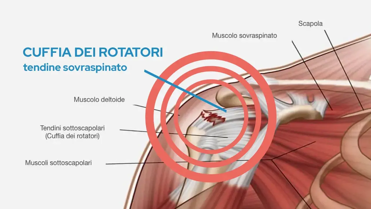Illustrazione anatomica della spalla che evidenzia l'infiammazione della cuffia dei rotatori, in particolare del tendine sovraspinato.