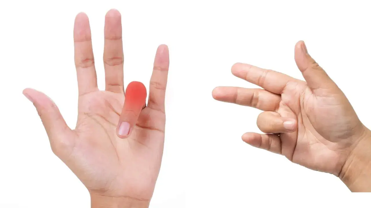 Mano con dito a scatto evidenziato in rosso, accanto a un'altra mano che esegue esercizi per il dito.