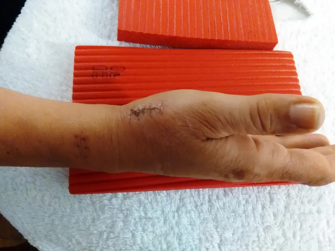 Mano con segni di sutura e taping per rizoartrosi pollice, appoggiata su asciugamano bianco con blocchi rossi.