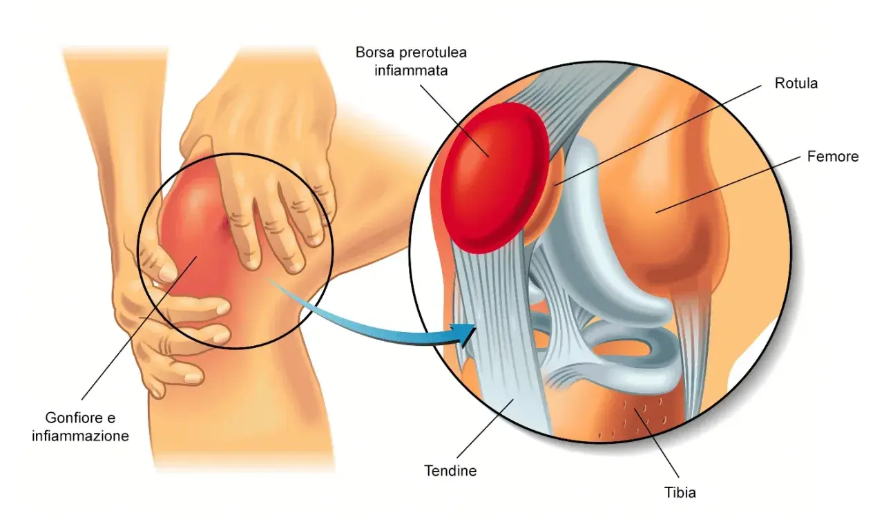 Ingrandimento di un ginocchio con gonfiore e infiammazione. La borsite al ginocchio è evidenziata, mostrando la borsa prerotulea infiammata.