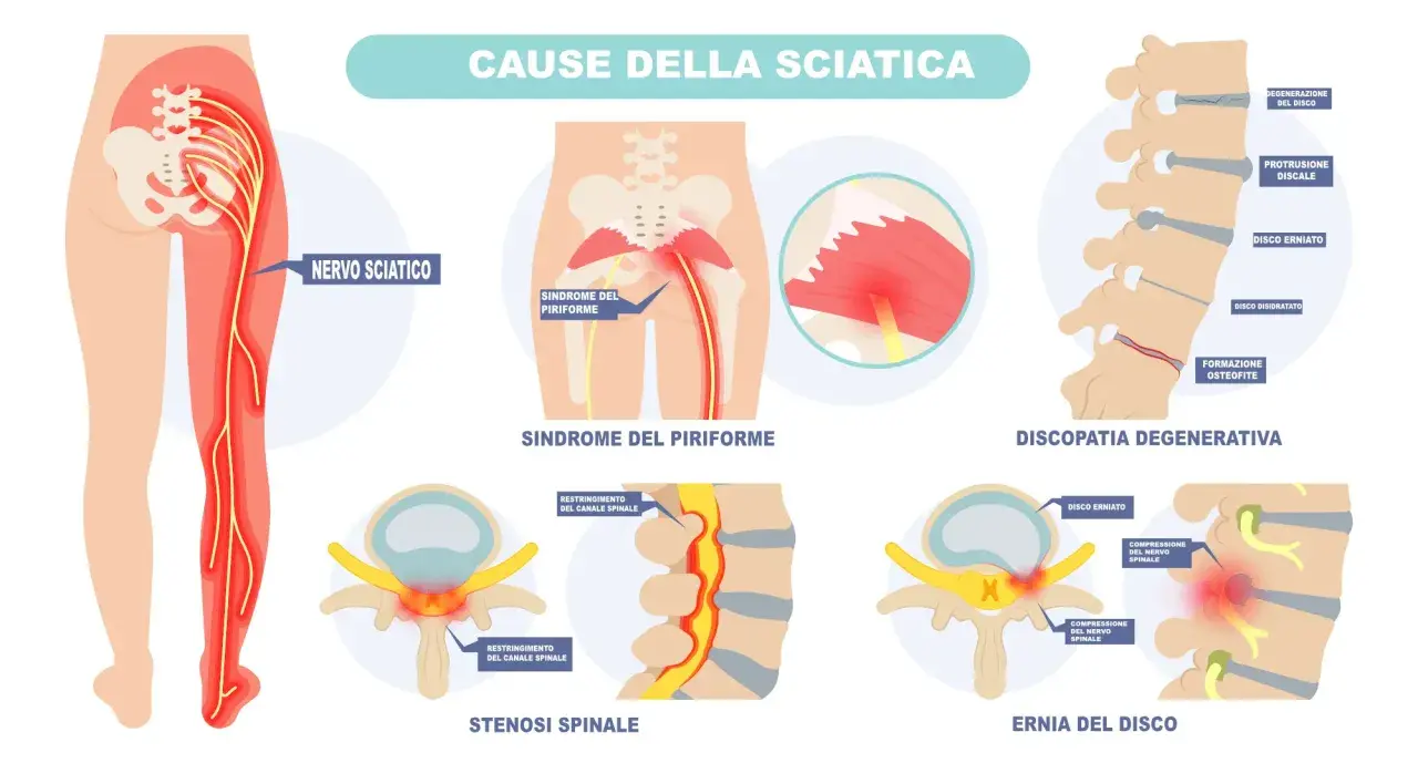 Illustrazione delle cause della sciatica: sindrome del piriforme, discopatia degenerativa, stenosi spinale ed ernia del disco, che provocano dolore al nervo sciatico.