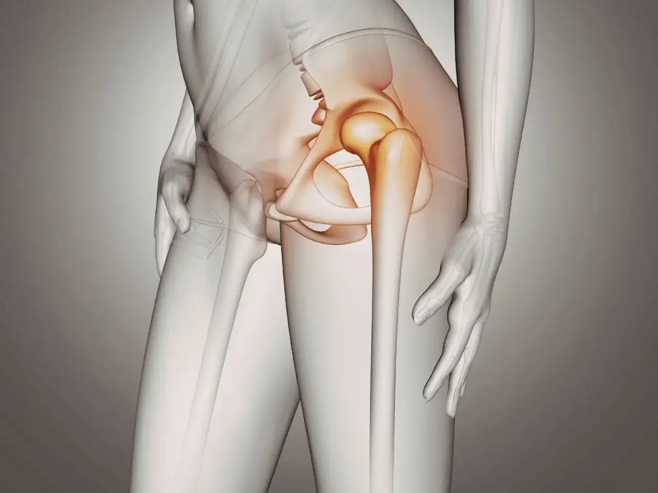 Illustrazione anatomica dell'anca con evidenziata la borsite trocanterica che non passa, causa di dolore persistente.