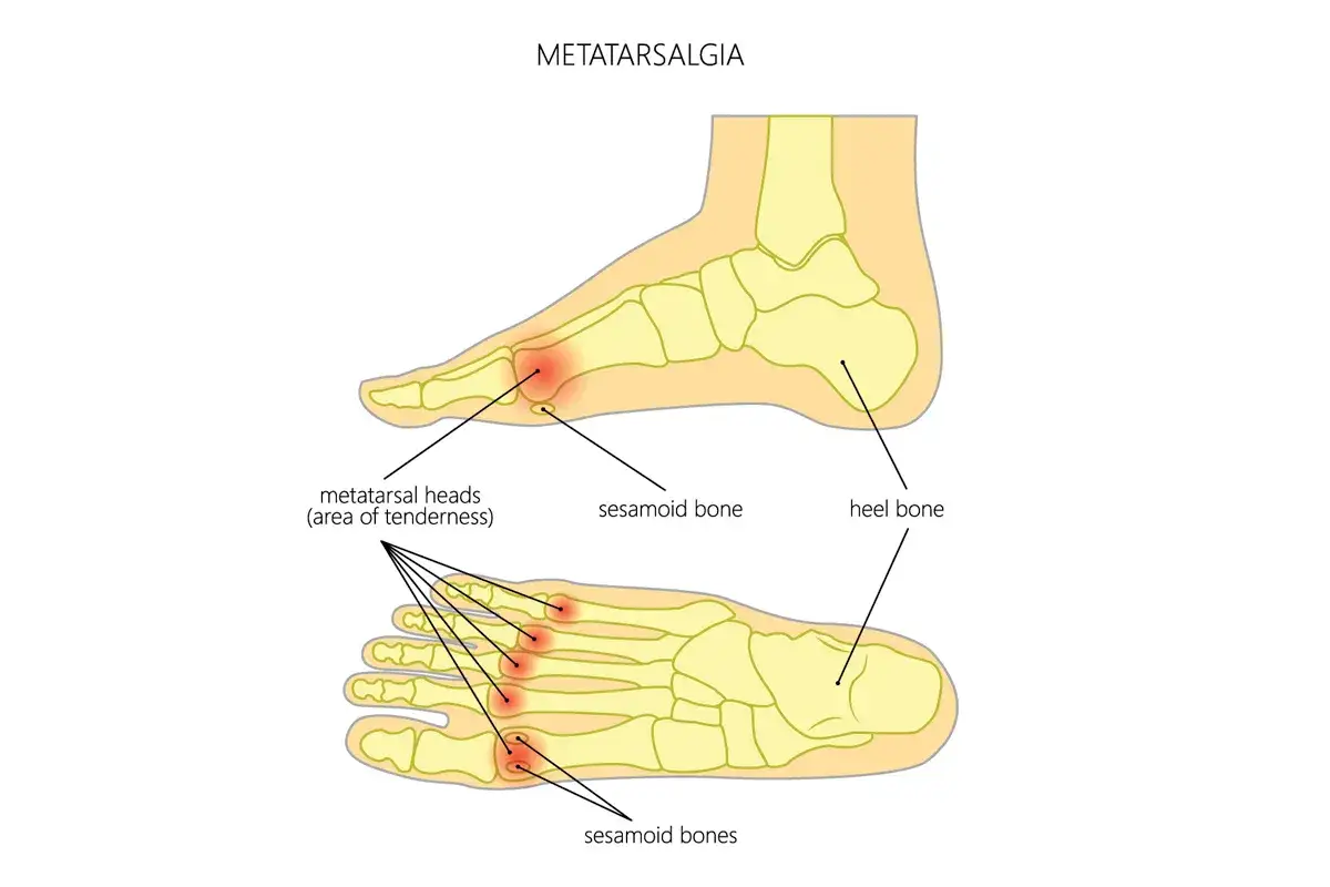 Illustrazione anatomica del piede che mostra l'infiammazione metatarso, con aree di dolorabilità evidenziate nelle teste metatarsali.